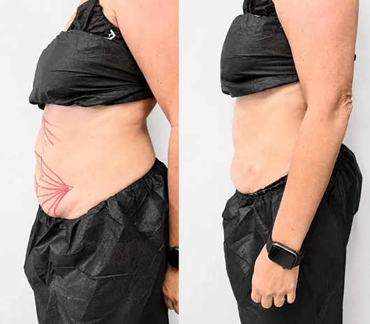 Resultado tratamiento de abdomen — antes y después