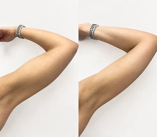 Resultado tratamiento de brazo — antes y después