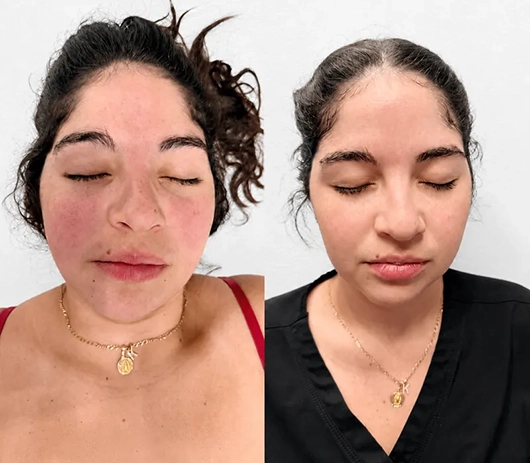 Resultado tratamiento facial — antes y después